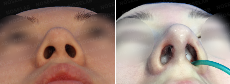 Nostrils before surgery (left), After surgery (right)