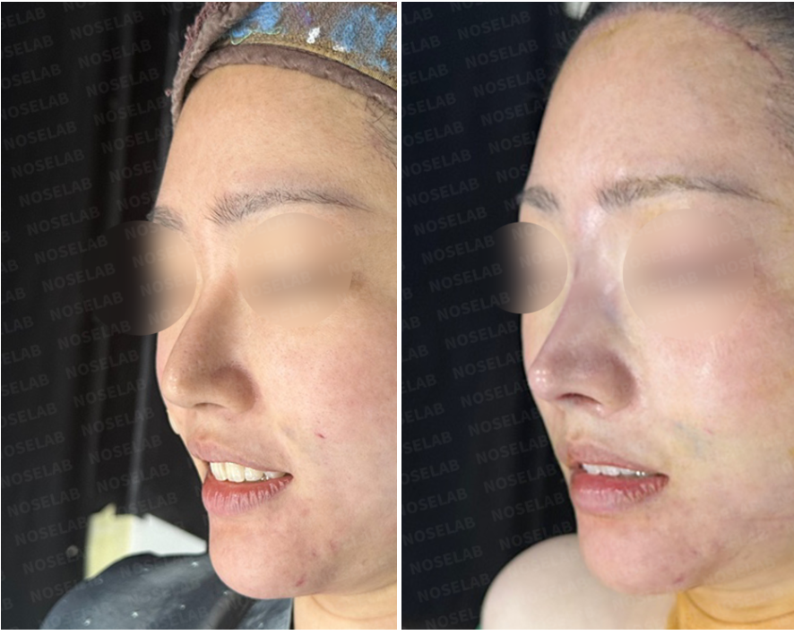 Oblique side view comparison before and immediately after revision rhinoplasty using rib cartilage for correction of a deviated and drooping nose.