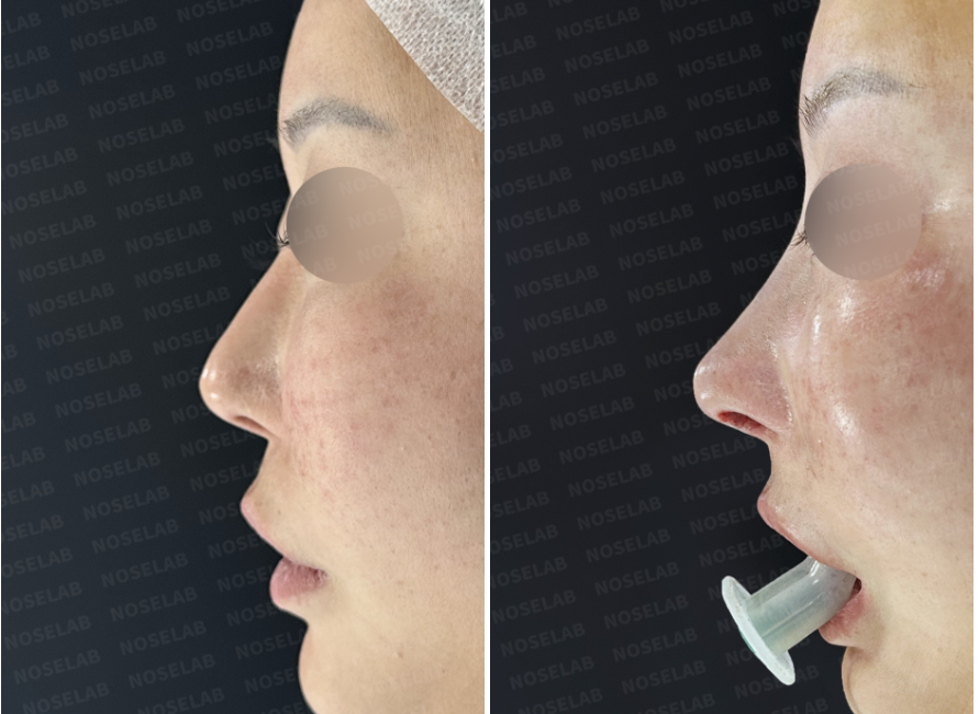 Before and immediately after surgery left lateral view comparison showing improved nasal profile and stabilized nasal structure following septal reconstruction in revision rhinoplasty.