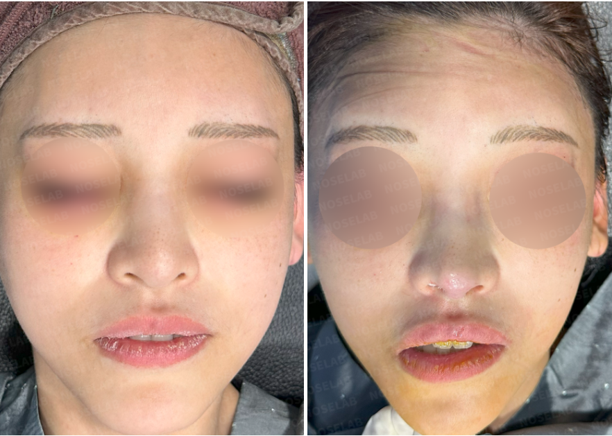 Before and after mesh removal rhinoplasty: frontal view showing refined nasal tip and improved balance