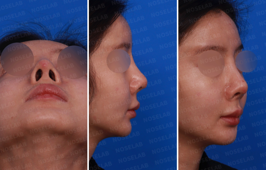 Preoperative design photos for emergency revision rhinoplasty: nostril view, right side profile, and oblique angle showing tip asymmetry and silicone exposure.