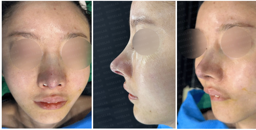 Immediately after emergency revision rhinoplasty: frontal, lateral, and oblique views showing restored nasal symmetry, refined tip contour, and stabilized nasal profile.