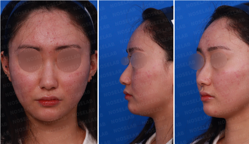 Preoperative consultation for crooked nose correction in Korea – frontal, oblique, and side profile views of a female patient before rhinoplasty.