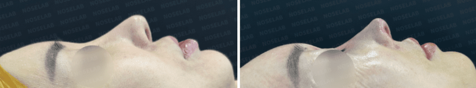 Side profile before and after long nose correction, showing improved droopy tip and natural bridge line.
