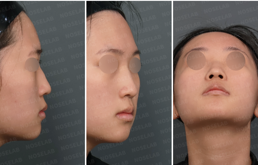 Preoperative design consultation photos showing drooping nasal tip, dorsal hump, and deviated nasal bridge with nostril asymmetry from right lateral, right oblique, and basal views.