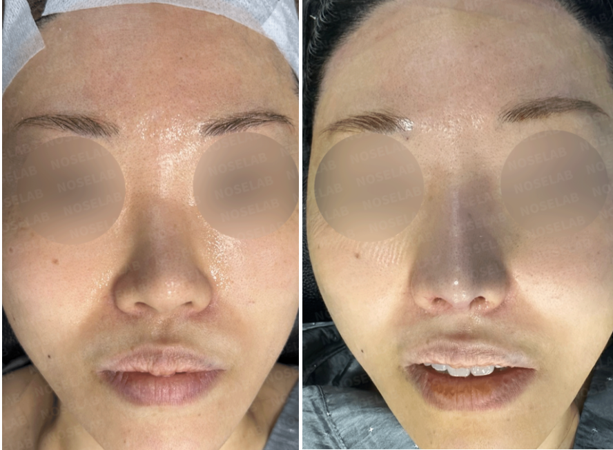 Frontal view before surgery (left) and immediately after revision rhinoplasty correcting nasal deformity from synthetic dermal graft absorption (right).