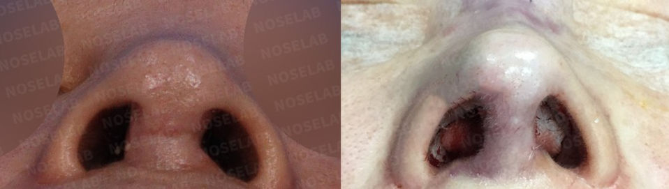 Photograph from the archive: Permanent Filler Removal and Nose Reconstruction Using Closed Rhinoplasty (image 2)