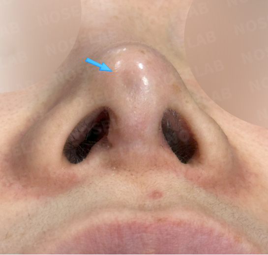 Pre-surgery nasal tip photo – nostril view showing skin depression, pigmentation, and scarring before Revision Rhinoplasty Korea with closed approach.