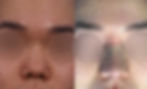 Front view before and after of Small and Short Nose Rhinoplasty Korea – balanced nasal tip projection and symmetry after closed rhinoplasty by Dr. Cha-Young Kang