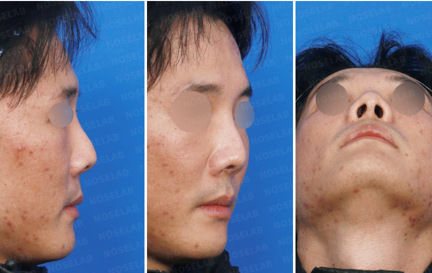 Preoperative nasal assessment before closed rhinoplasty Korea, showing right side view, right oblique view, and nostril view in a patient with nasal deviation, tip asymmetry, and contracted nasal structure prior to revision surgery.