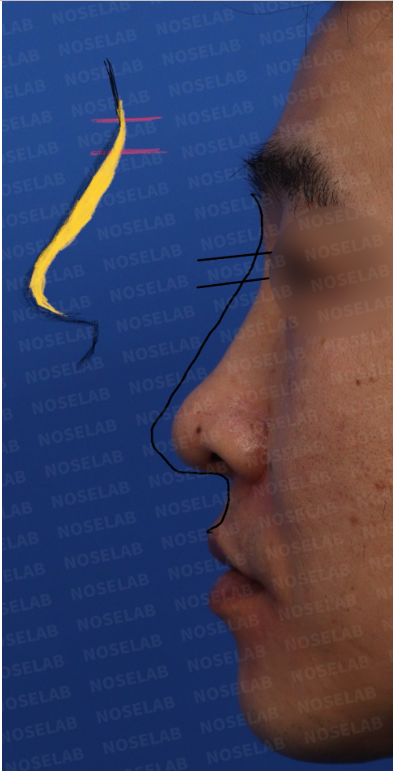 Side profile before arrow nose correction showing droopy tip and flat nasal dorsum