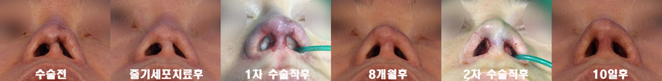 Nostril view comparison of skin necrosis and contracted nose repair using autologous rib cartilage — pre-op, post stem cell treatment, first surgery, 8 months later, second surgery, and 10 days after operation at NoseLab Seoul