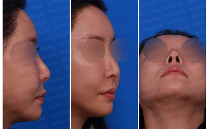 Preoperative consultation photos for closed rhinoplasty in Korea: Right side view, right oblique side view, and nostril view showing nasal tip transparency and midface proportion issues.