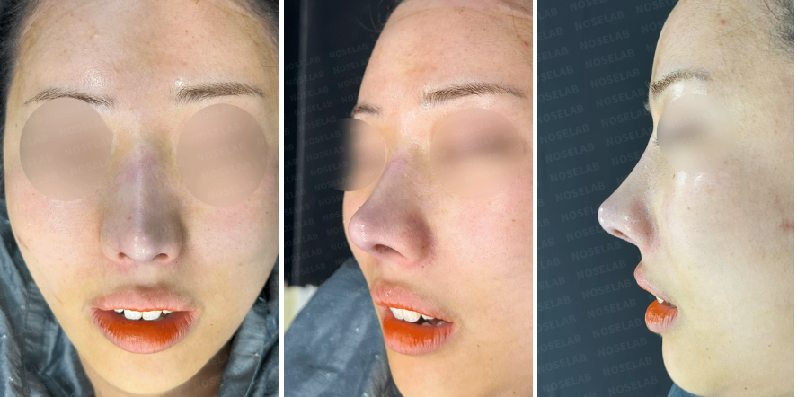 Immediately after customized nasal reconstruction – frontal, oblique side, and side views showing lowered nasal bridge, refined tip, and improved facial harmony.