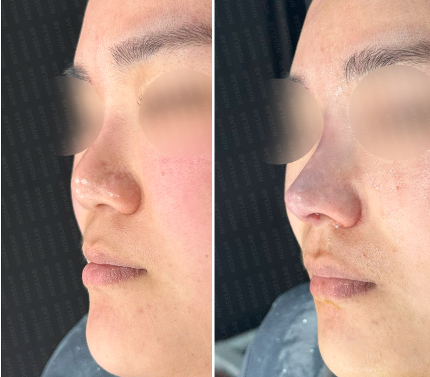 Oblique side view before and after thread lift removal and natural nose line correction surgery.