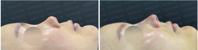 Before surgery (left), after surgery (right)
