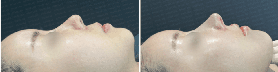 Side profile view before surgery (left) after surgery (right)