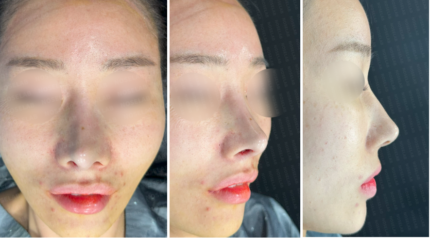 Immediately after rhinoplasty surgery: frontal, oblique side, and side view photos showing corrected nasal line