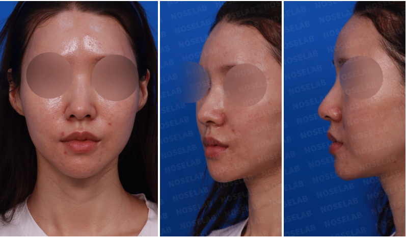 Frontal, oblique, and side view of a female patient during preoperative rhinoplasty consultation at NoseLab Clinic.