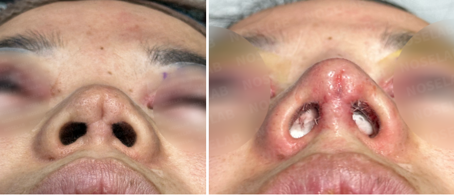 Short nose and columellar depression correction – nostril view before surgery (left) and after revision rhinoplasty (right)