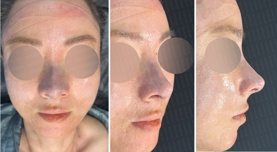 Immediately after droopy nose and hump correction rhinoplasty – frontal, oblique, and side views showing refined bridge, lifted nasal tip, and improved symmetry.