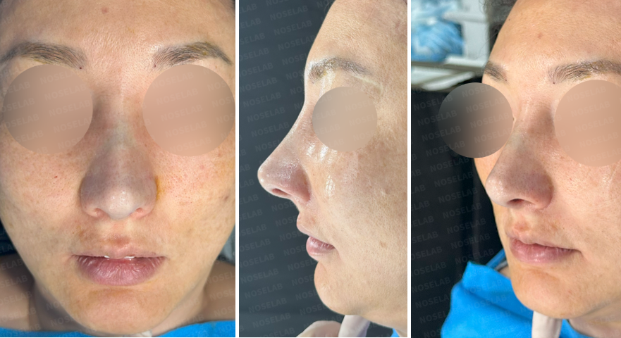 Immediate post-operative frontal, lateral, and oblique views after revision rhinoplasty for correcting crooked nose and bulbous tip using rib cartilage graft.
