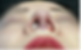 Nostril view immediately after closed rhinoplasty, showing improved symmetry and refined nasal base.