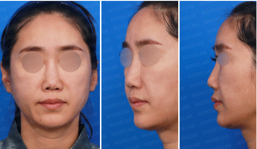 Preoperative consultation photos before illegal filler removal and septal reconstruction, showing frontal, left oblique, and side views for surgical evaluation.