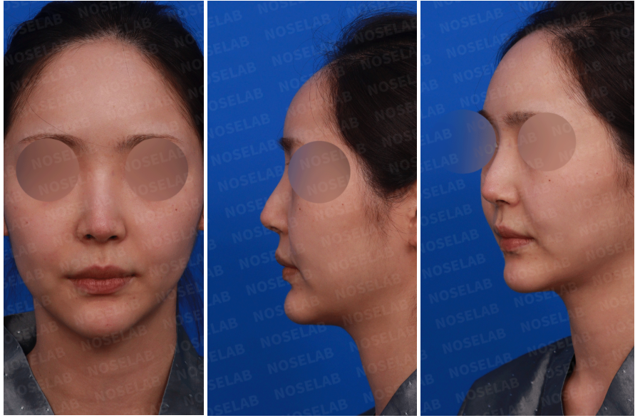 Correcting Drooping Nasal Tip and Nasal Obstruction – Frontal, Left Side, and Oblique View before rhinoplasty at Nose Lab Clinic