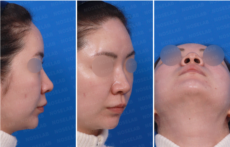 Preoperative right-side and nostril views for Bulbous Tip Rhinoplasty Korea showing wide tip.