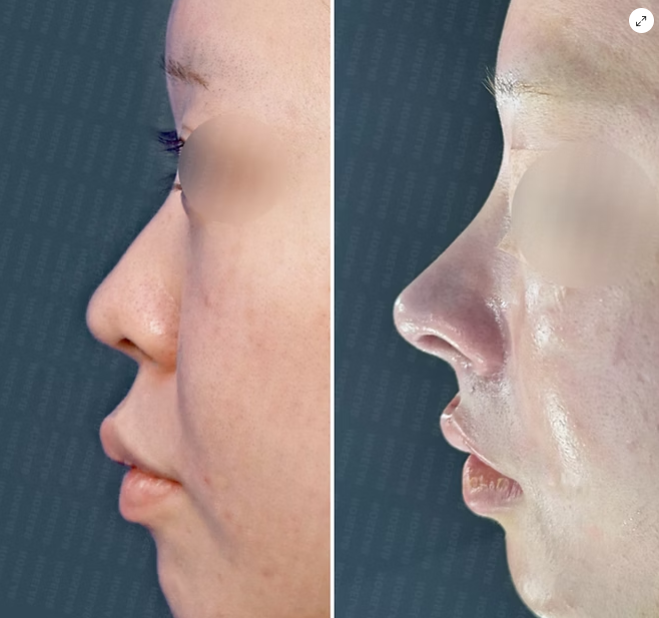 Case Study: Bulbous Nose Correction and Wide Nasal Bridge – Functional and Aesthetic Rhinoplasty in Korea