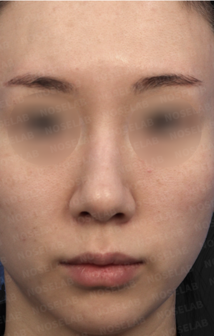 Frontal view before bulbous nose surgery – blunt and wide nose with slight deviation and nostril asymmetry.
