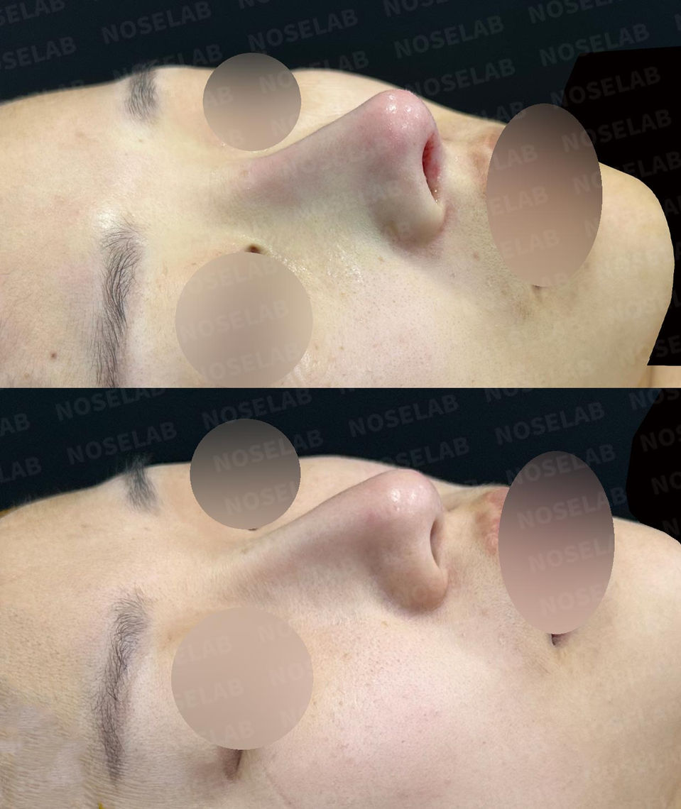 Right 45-degree lateral view before and after Deviated and Droopy Nose Correction – Closed Rhinoplasty Korea