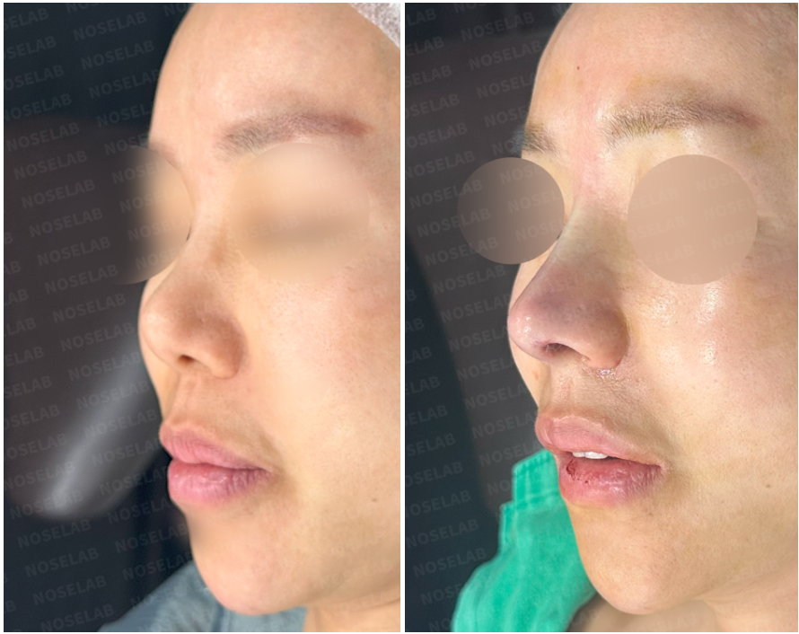 Oblique side view comparison before and immediately after secondary rhinoplasty, highlighting improved nasal projection and symmetrical nostrils.