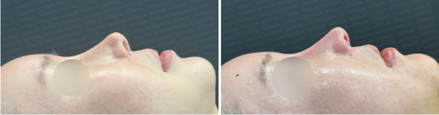 Before and after photos of Upturned Nose Correction surgery: side view comparison (Left: before surgery, Right: immediately after surgery).