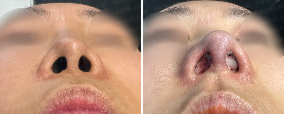 Nostrils before surgery (left) after surgery (right)