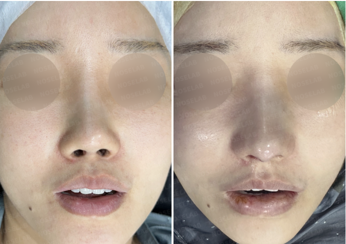 Frontal before and immediately after views showing reduced nostril show after short upturned nose revision rhinoplasty.