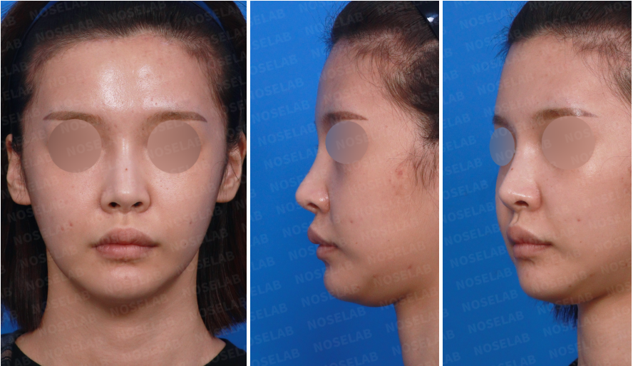 Preoperative views showing high nasal radix before High Radix Rhinoplasty Korea.