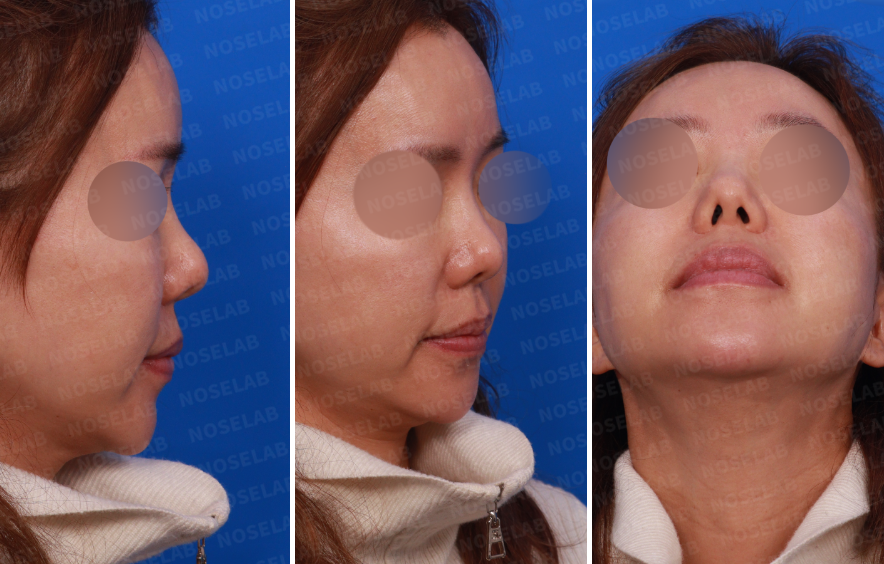 Design consultation photos showing the patient’s right profile, oblique side, and nostril base views before secondary rhinoplasty after silicone removal.