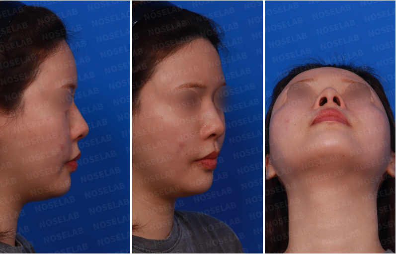 Preoperative design consultation photos for nostril asymmetry correction: right side view, right oblique side view, and nostril view