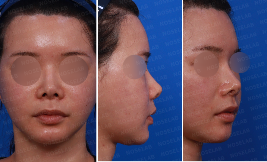 Preoperative consultation images showing frontal, left side, and oblique views of a patient with nasal deviation and upturned nasal tip prior to revision rhinoplasty.