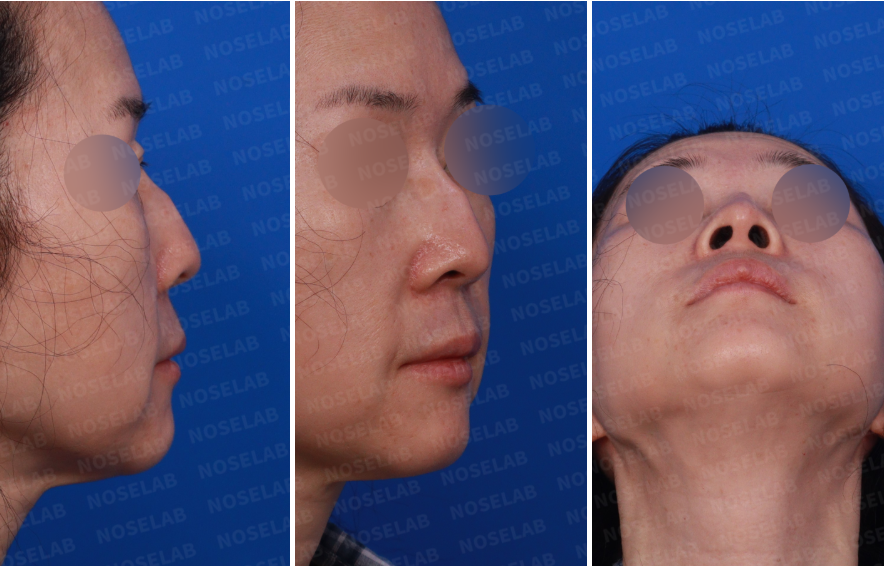 Preoperative rhinoplasty photos showing right side view, right oblique view, and nostril base view – highlighting dorsal hump and nostril asymmetry due to long-term silicone implant calcification.