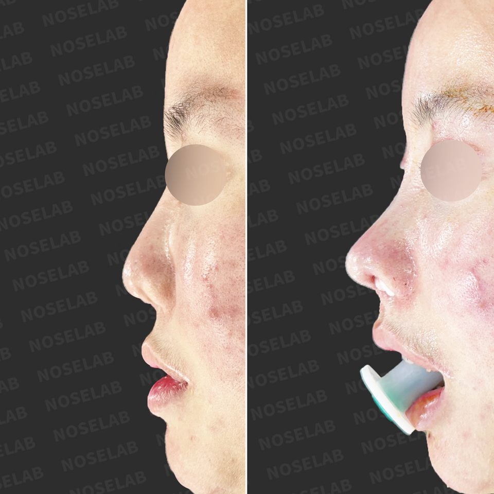 Profile comparison: before surgery (left), immediately after surgery (right).