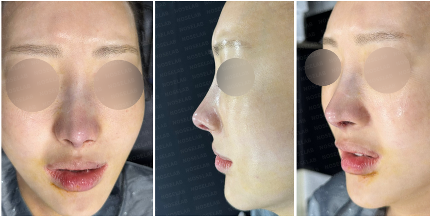 Immediately after surgery: Frontal, side, and oblique side view photos showing correction of nasal tip cartilage show-through and improved nasal contour.