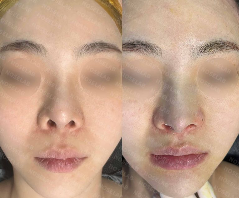 Front-facing comparison revealing decreased nostril exposure and enhanced facial harmony post-revision procedure