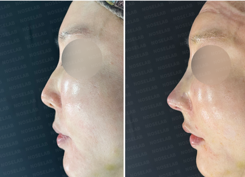 Left profile before revision rhinoplasty (left) and immediately after surgery (right) – dorsal hump reduced, nasal tip projection enhanced.