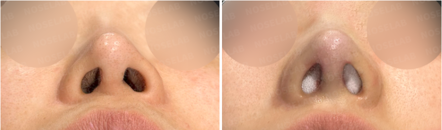 Before and immediately after structural reconstruction rhinoplasty – basal view showing improved nostril symmetry, refined columella alignment, and balanced nasal base shape.
