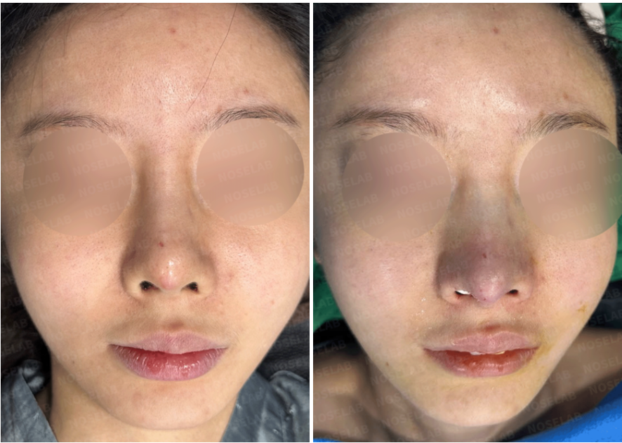 Before and immediately after emergency revision rhinoplasty: frontal view showing correction of nasal tip exposure and nostril asymmetry.