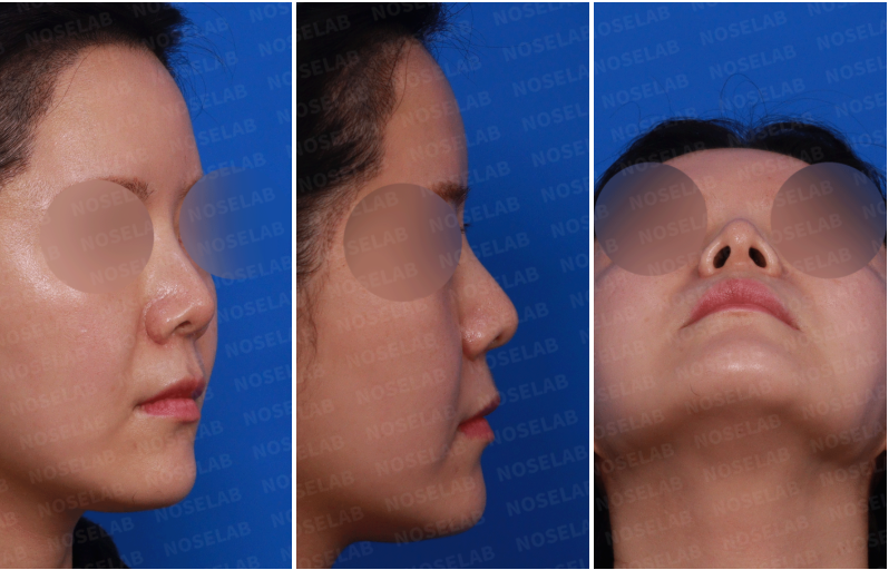Preoperative consultation images showing right side view, right oblique view, and nostril view of a patient with nasal asymmetry and short nose before revision rhinoplasty.