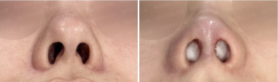 Nostril view before and immediately after autologous rib cartilage rhinoplasty